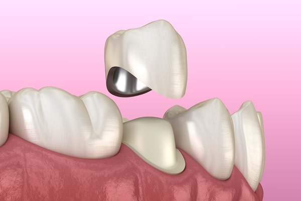 dental-crowns-bridges-saskatoon
