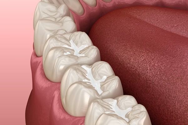 dental-fillings-saskatoon