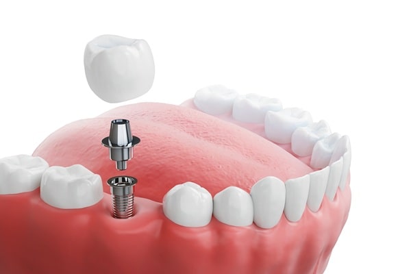 dental-implants-all-on-4-saskatoon