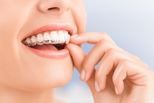 everyday-life-with-aligners