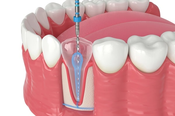 how-the-procedure-works-root