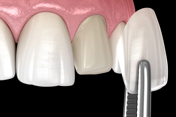 how-veneers-work