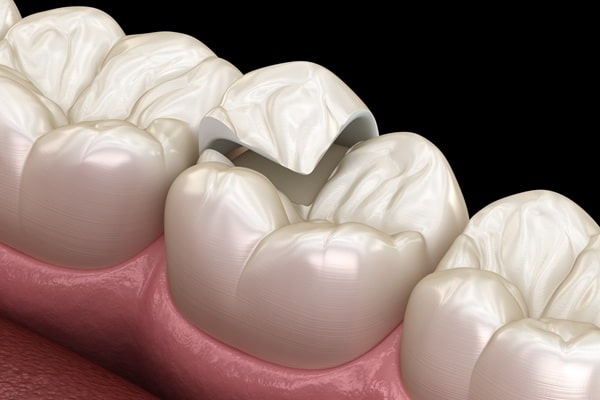 inlays-onlays-saskatoon