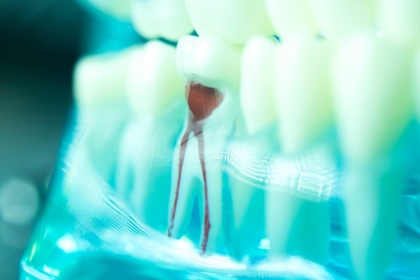 root-canals-saskatoon