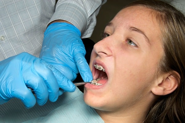 what-the-process-looks-like-braces