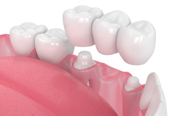 when-a-bridge-is-suggested