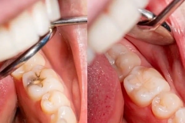 when-filling-is-needed