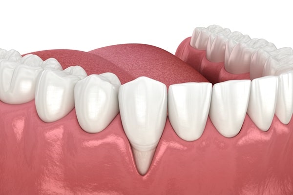 why-grafting-may-be-needed